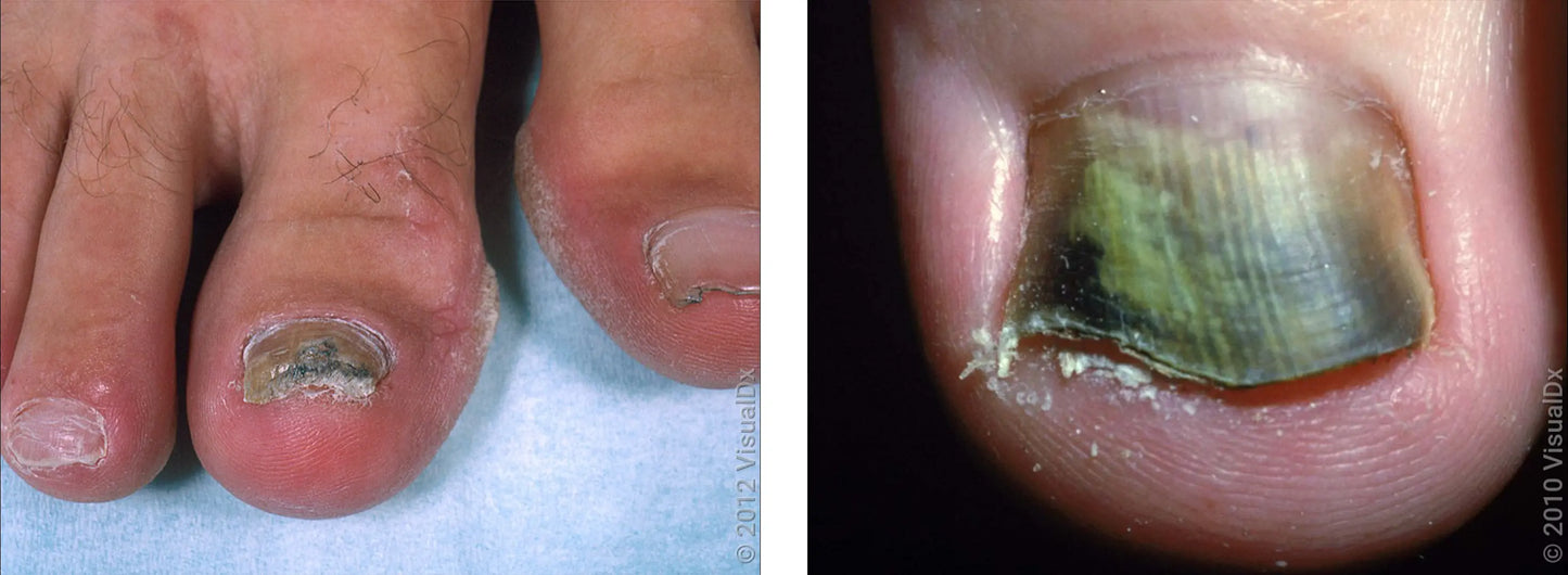 Amorolfine Fungicros Nail Lacquer 2.5 ml – Amorolfine-Based Anti-Fungal Nail Treatment for Fungal Infections. Shopnice.com