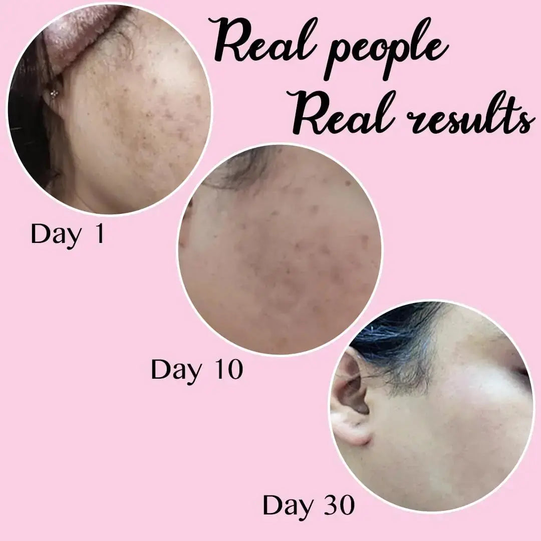 Melas Face Cream 10gm (Pack of 3) | Anti-Pigmentation, Dark Spot Removal & Skin Brightening Cream V2deliver.com