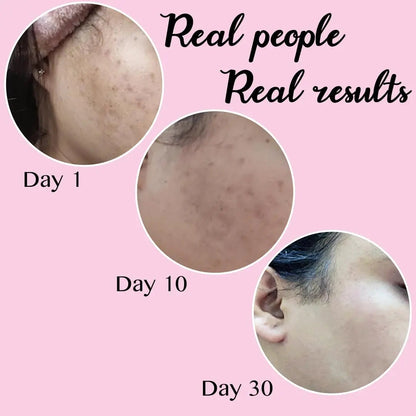 Melas Face Cream 10gm (Pack of 3) | Anti-Pigmentation, Dark Spot Removal & Skin Brightening Cream